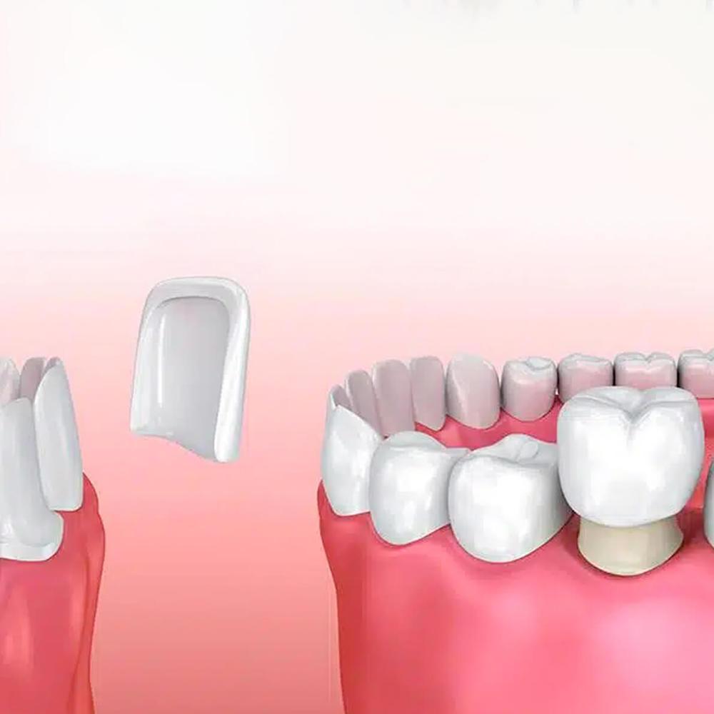Dental World Manila Dental Crowns and Veneers-compressed